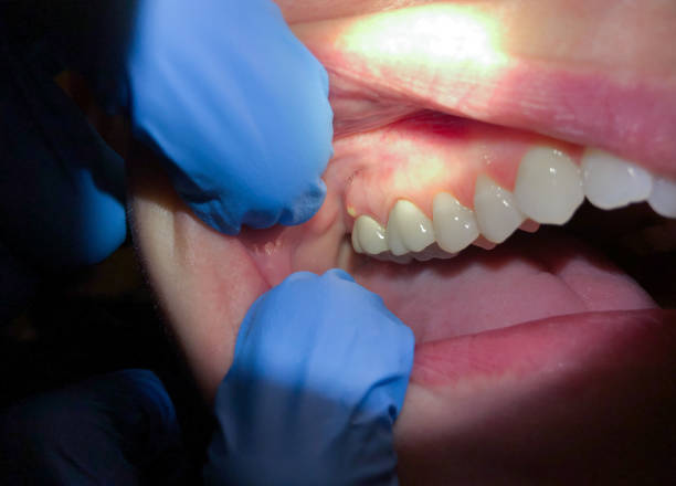 Best Tooth Infection Emergency Dentist  in Hedwig Village, TX